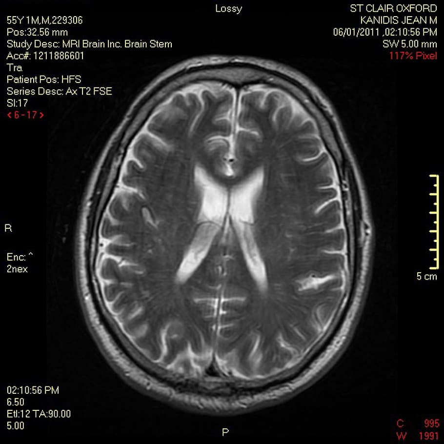 mri demyelinating lawyers. Post Traffic Accident Therapy And "Triggering Events