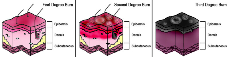 Diagram of Burn Degrees. Contributed by Wikimedia Commons (Public Domain)