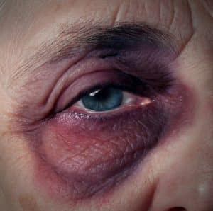 Black eye. I Suspect Financial Abuse of a Senior Citizen — What Must I Do?