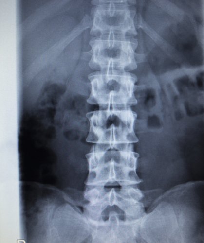 Spinal column facet joint xray