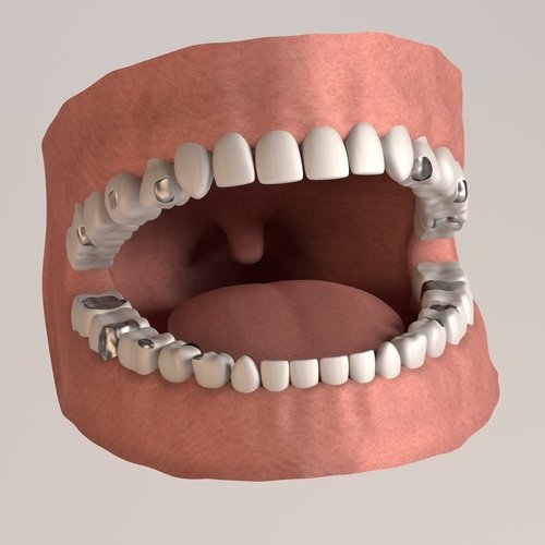 Dangers of Mercury dental work.