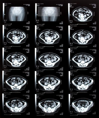 ER Xray of pelvic injuries.