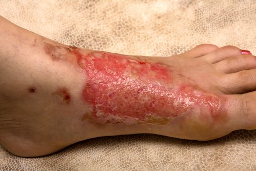 Burned top of a human foot