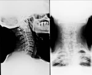 Whiplash X ray image
