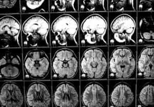 Brain injury x-ray . Are Healing Brain Oils A Fraud or a Miracle?