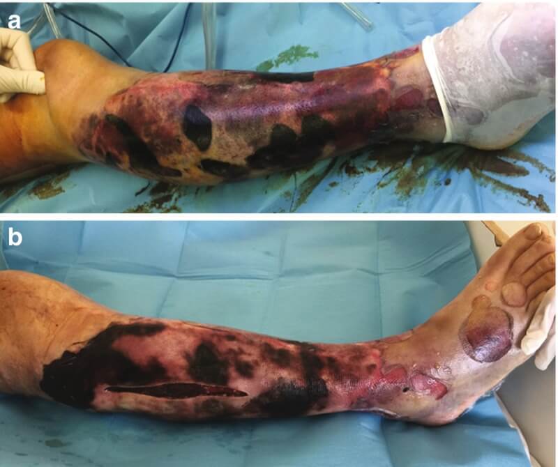 Massive crush injury of the leg due to a car accident! Crush injuries occur  when a crushing force is applied to a body area. Sometimes they are  associated with internal organ rupture