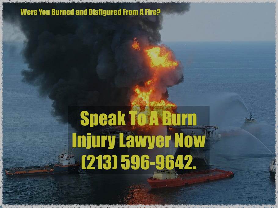 Local burn injury lawyer