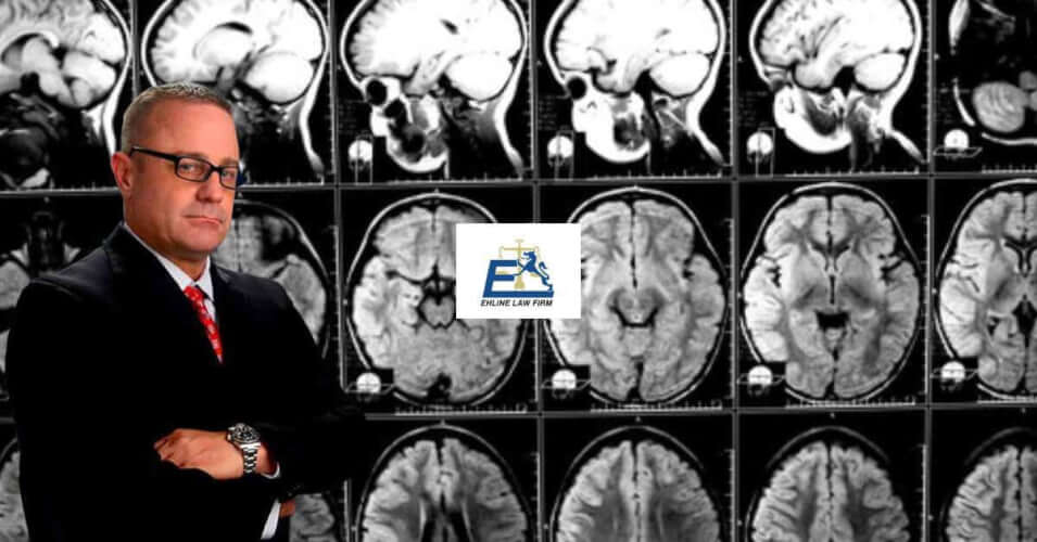 Brain Injury Attorneys In Los Angeles